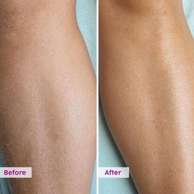 Plix Pineapple 5% Lactic Acid Exfoliating Body Wash, 236ml | For Tan Free & Brighter Skin