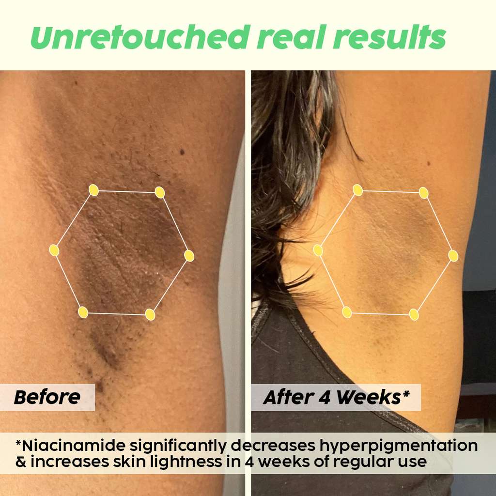 Plix Pineapple Underarm Depigmentation Serum Spray For Dark Underarms, 200ml